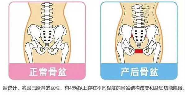 骨盆修复真的有效果吗？有必要做吗？(图1)